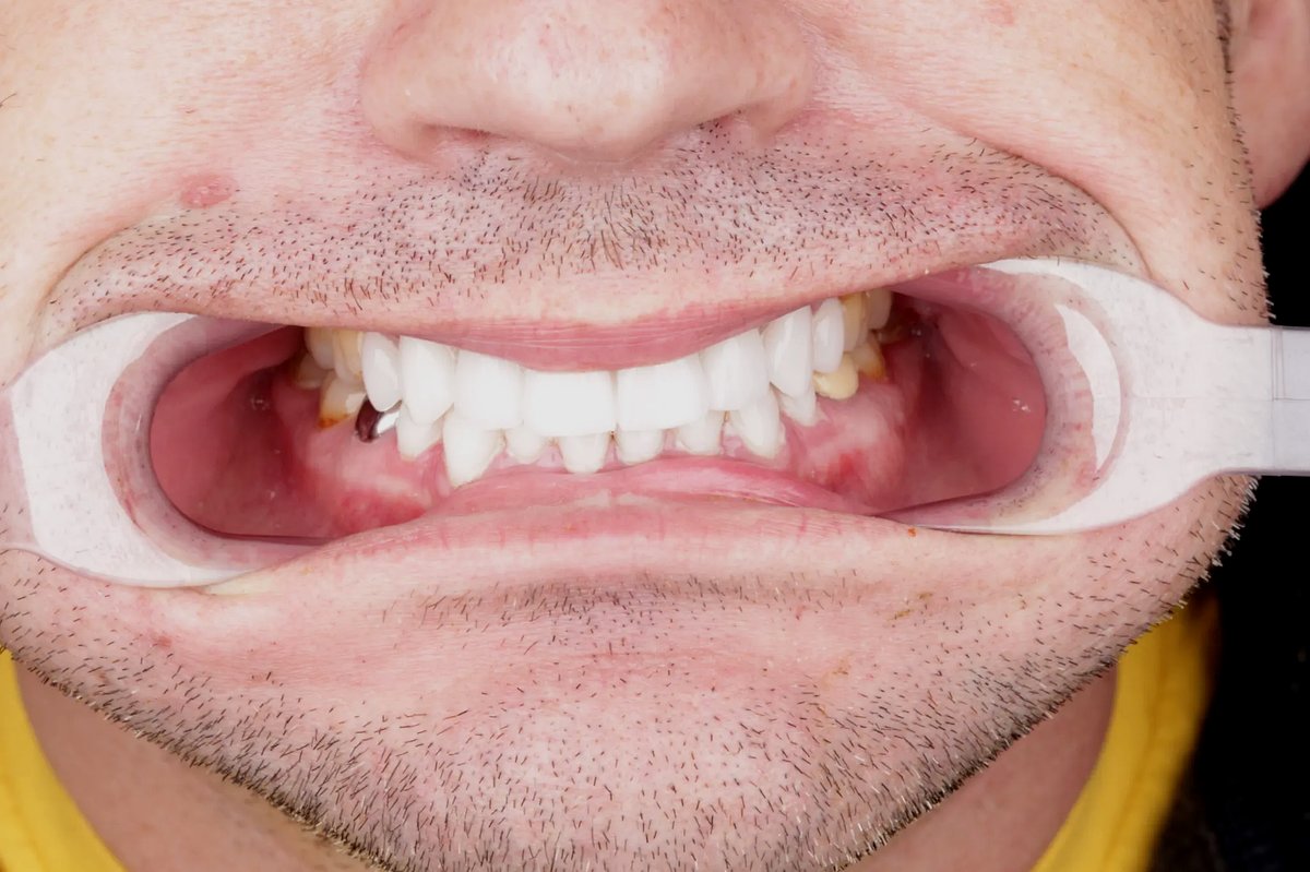 Brandon K. after — retracted view showing new E.max bridge and veneers upper arch, composite...