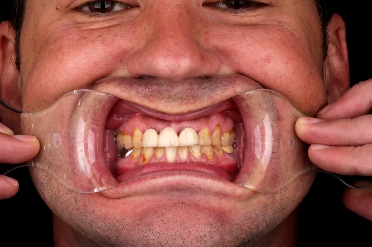 Brandon K. before — retracted view showing mismatched bridge and discolored composite build-ups