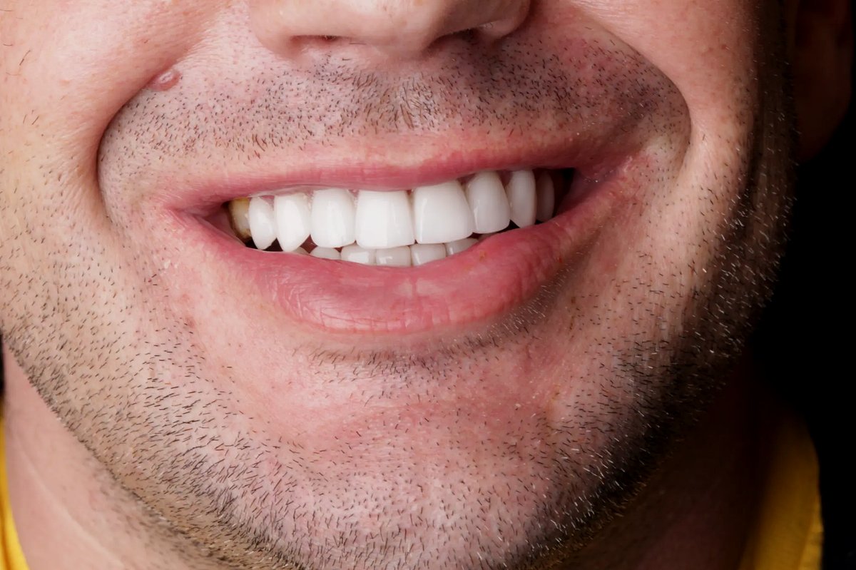 Brandon K. after — smile view showing full upper arch E.max veneers and bridge, shade B1