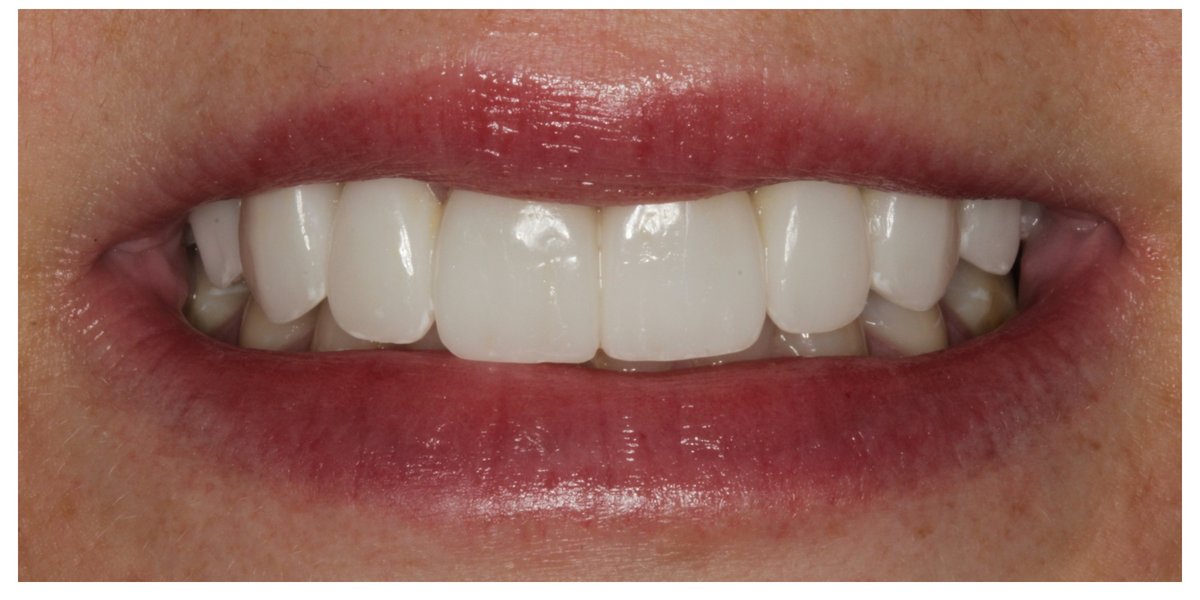 Andrea's Case after veneers