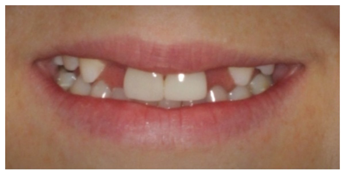 Andrea's Case before veneers