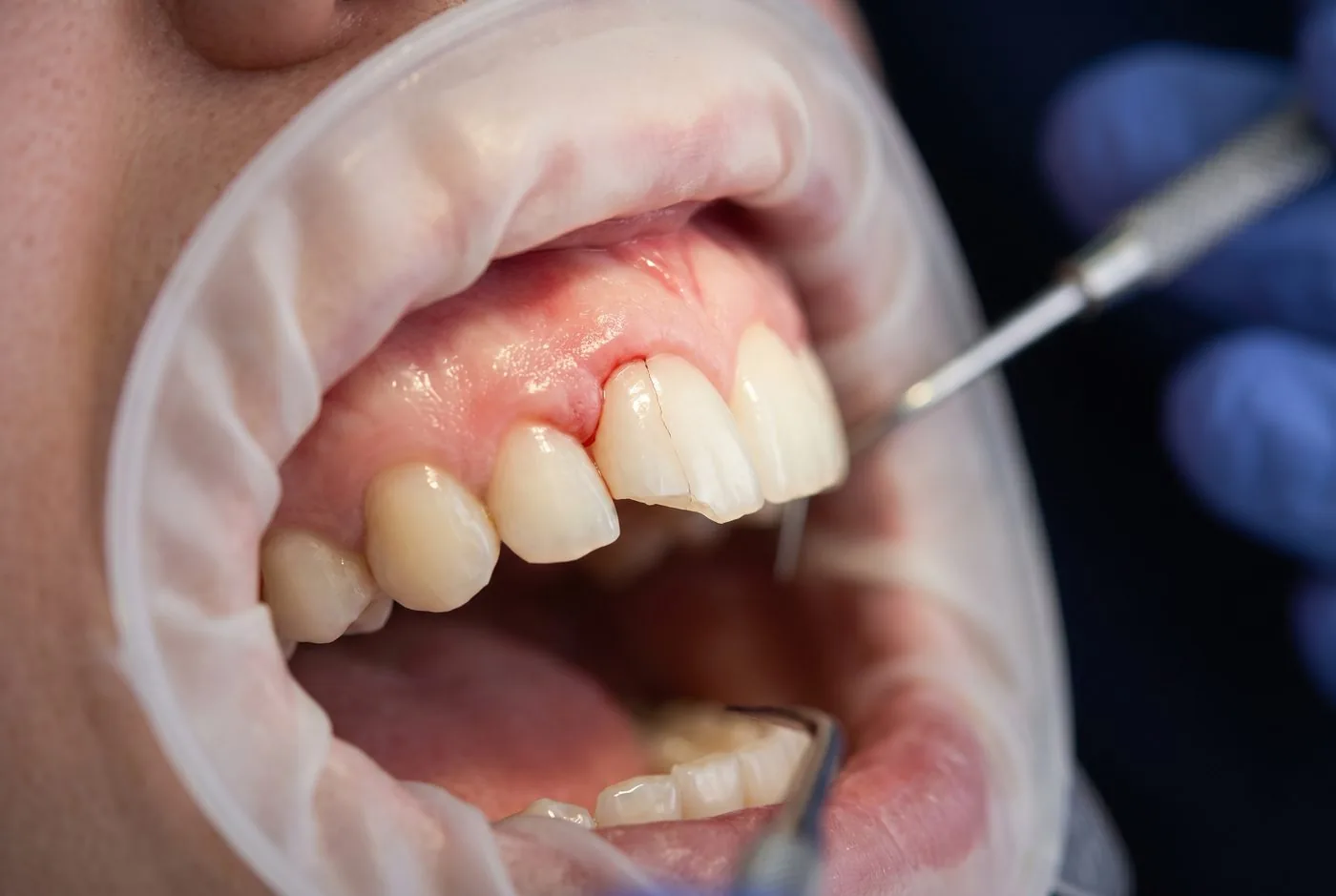 Clinical photo showing a chipped veneer margin and gum inflammation from a poorly fitted veneer