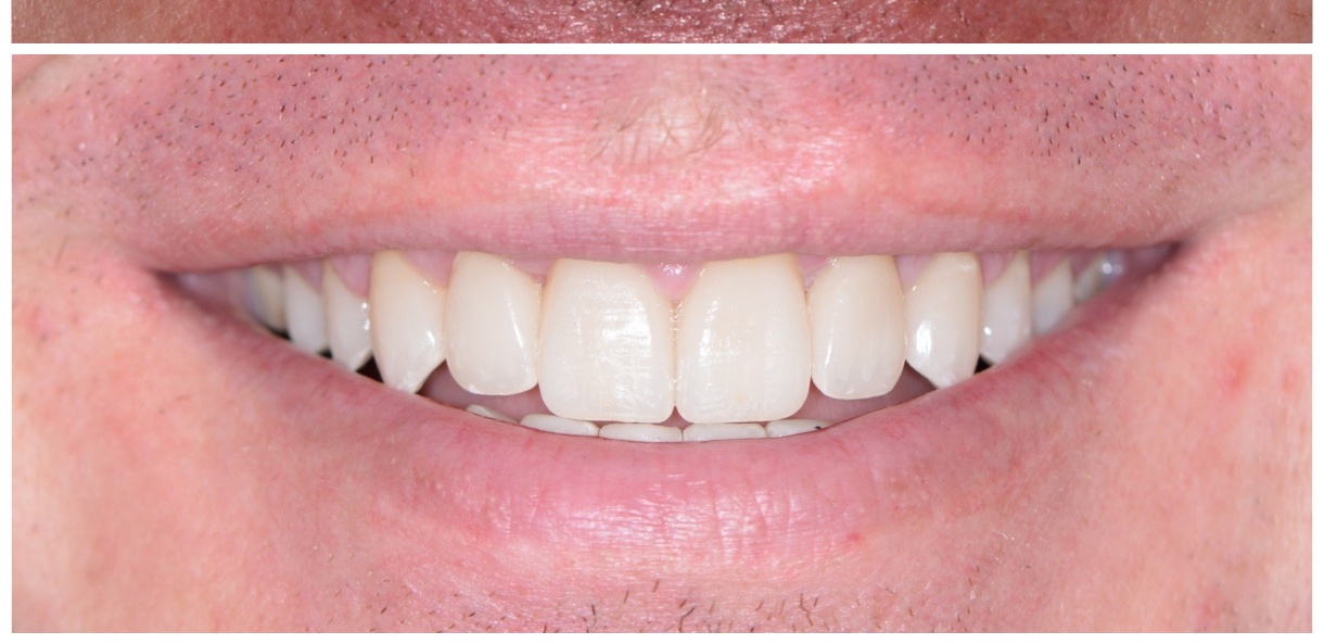 Gap closure after veneers