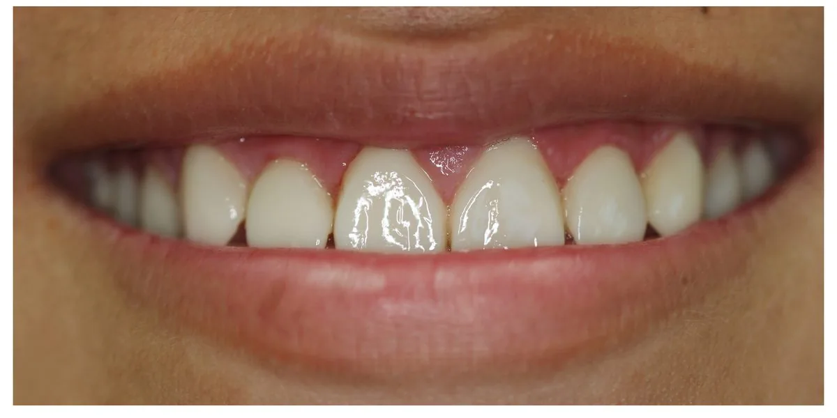 Alex after — bright, confident smile with 8 no-prep composite veneers in B1 shade