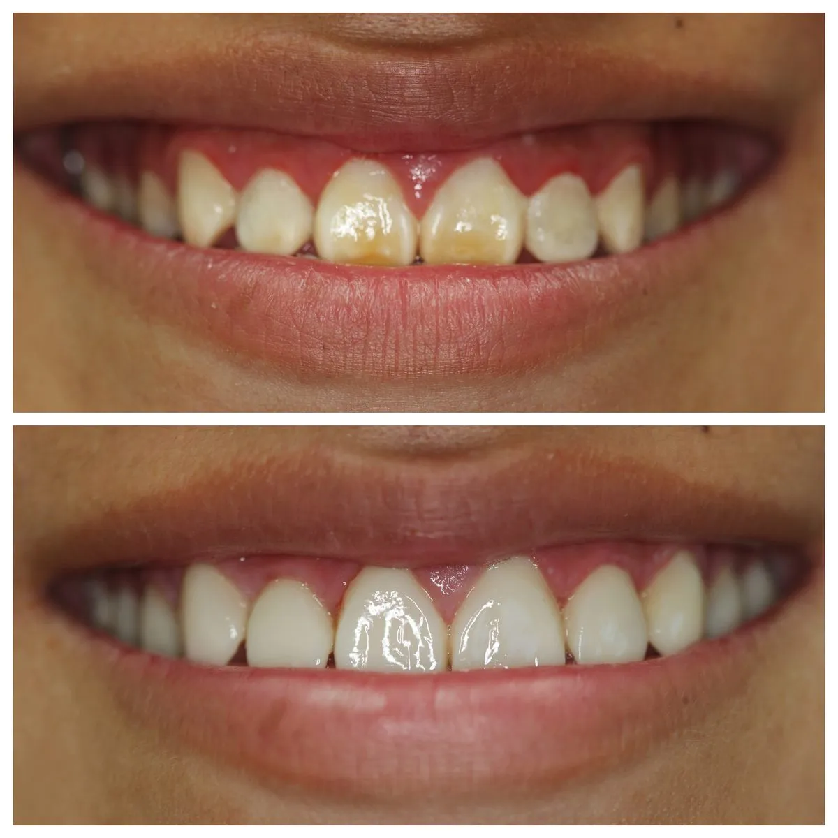 Alex before and after composite veneers — intrinsic staining corrected with 8 no-prep...