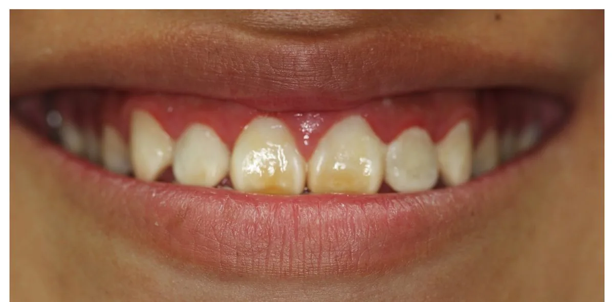 Alex before — intrinsic staining, self-conscious about smiling