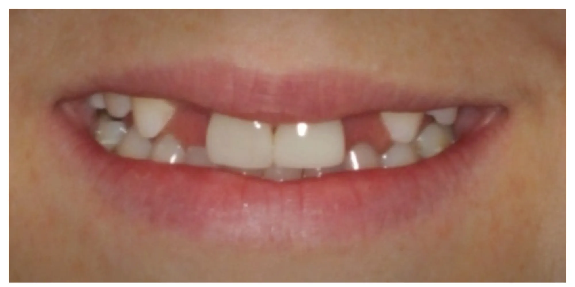 Andrea before treatment — gaps from congenitally missing upper lateral incisors