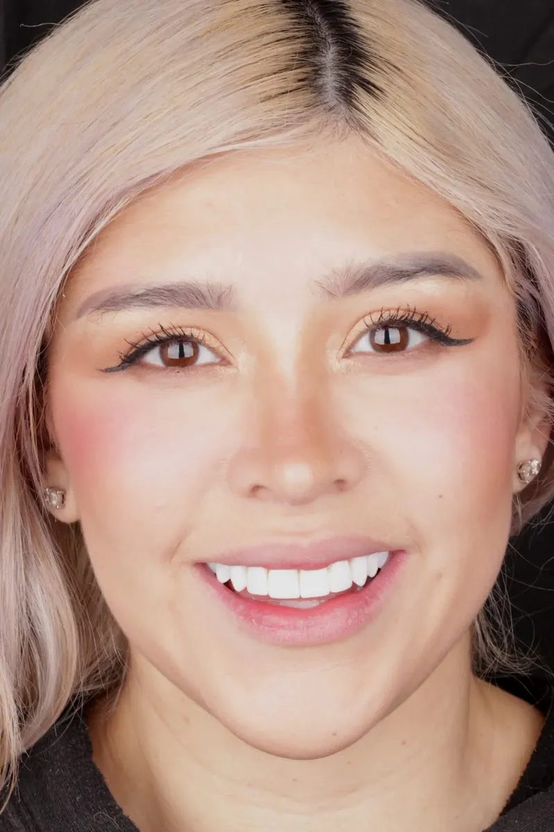 Apollonia after — 10 no-prep composite veneers in BL shade