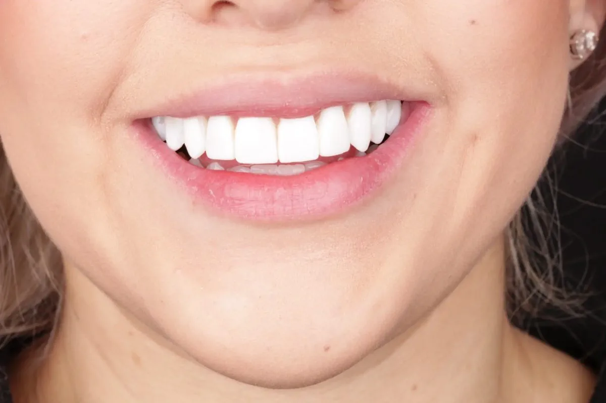 Apollonia after — 10 composite veneers in BL shade, full smile corridor, camera-ready result