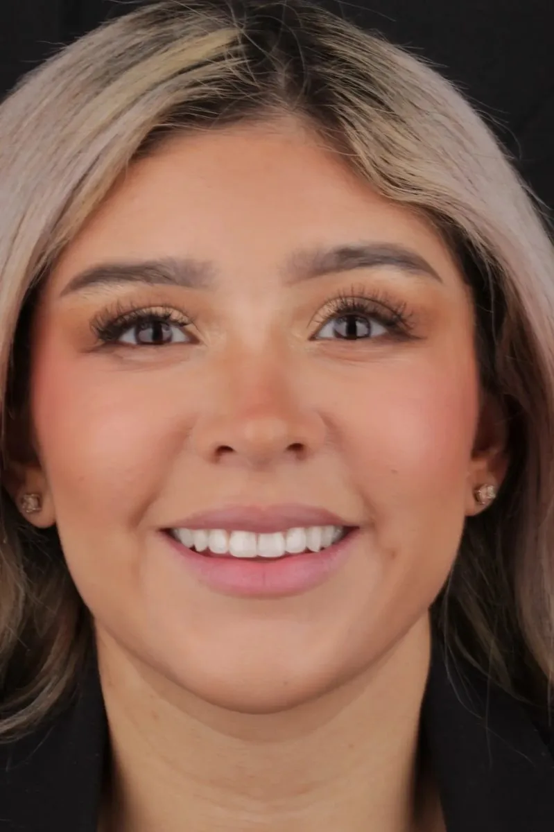 Apollonia before — natural teeth before composite veneers