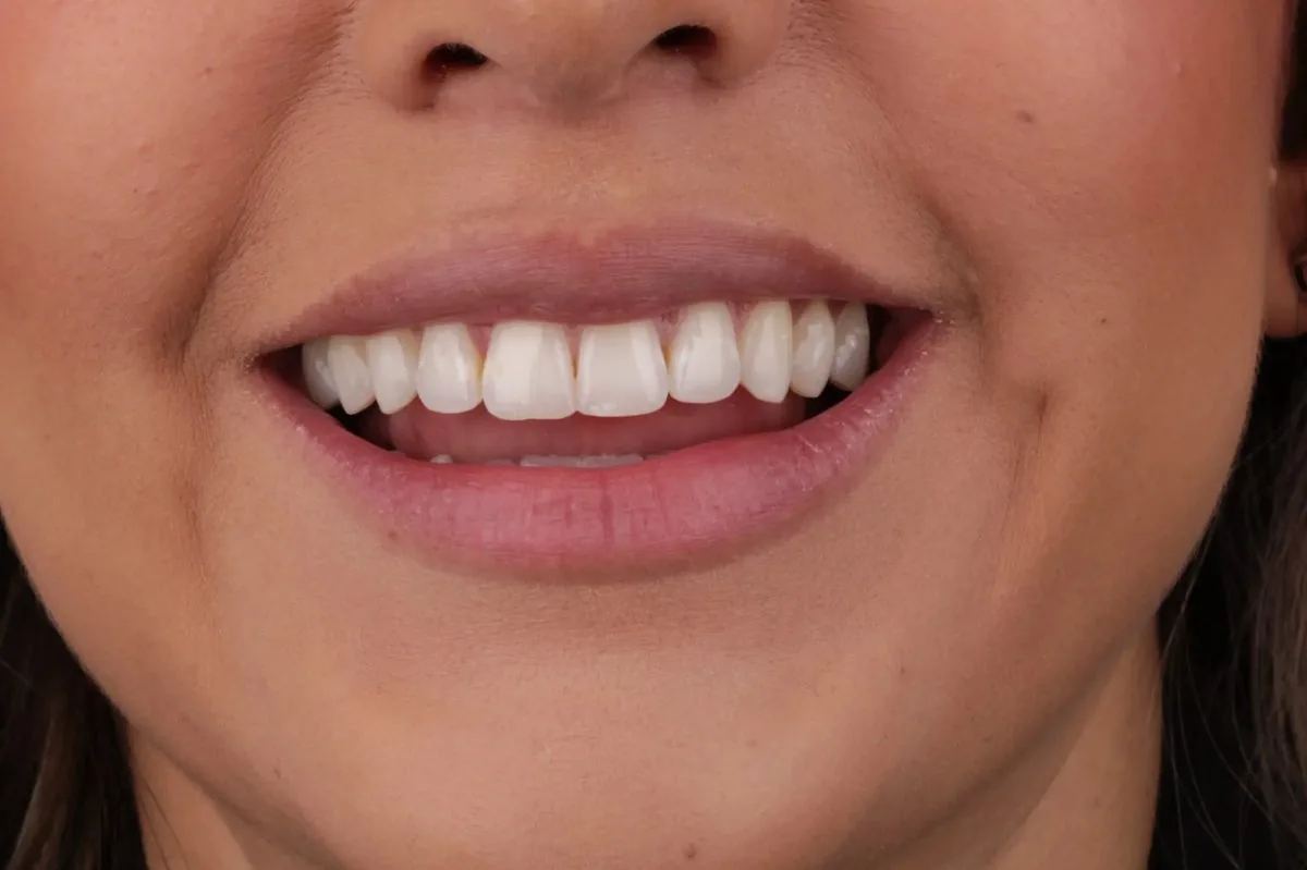 Apollonia before — shorter teeth with slightly yellow coloration and narrower smile