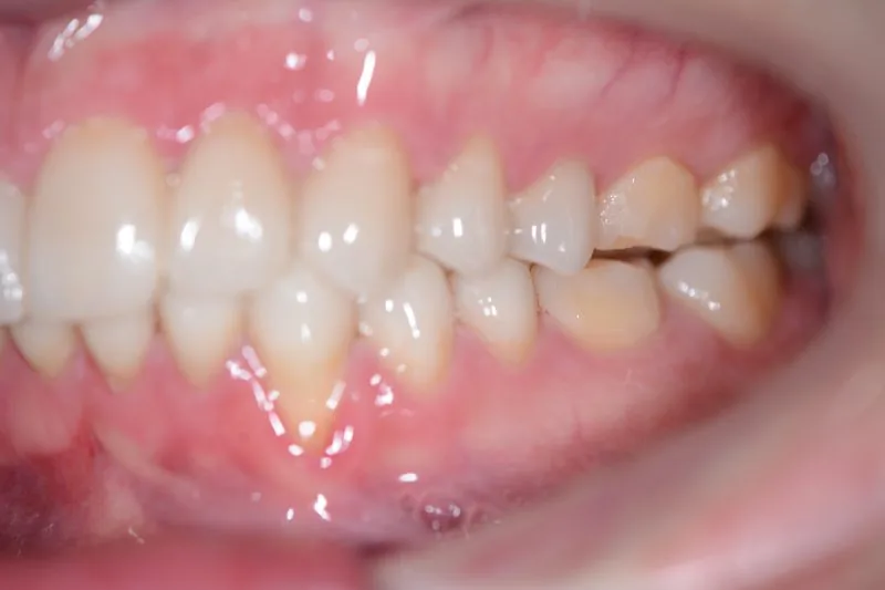 Lateral view showing bite opening before anterior veneer placement