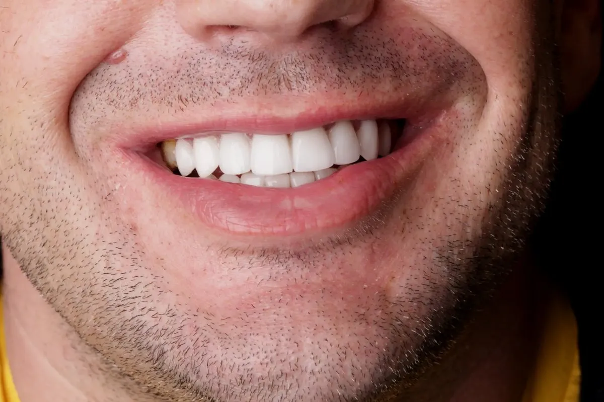 Brandon K. smiling after E.max and composite veneer treatment at Lakewood Complete Dentistry
