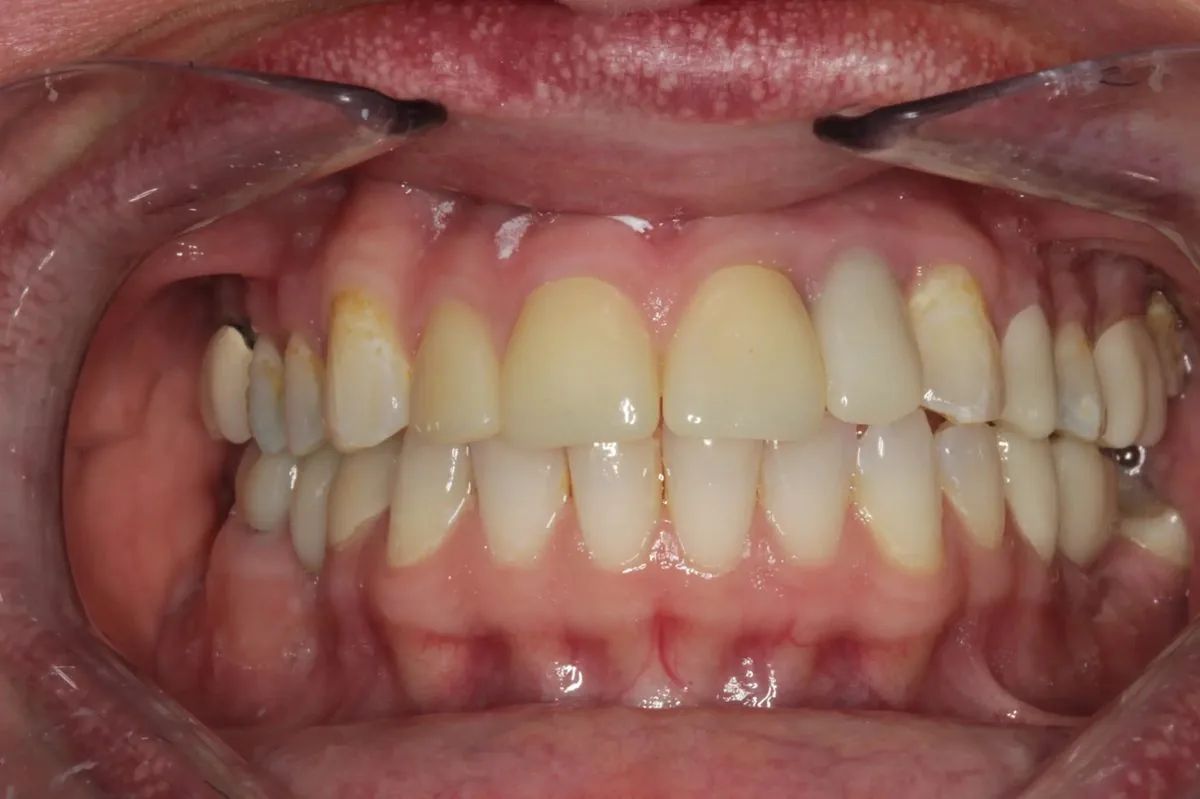 Catherine before — retracted view showing discolored composite build-ups and mismatched crowns