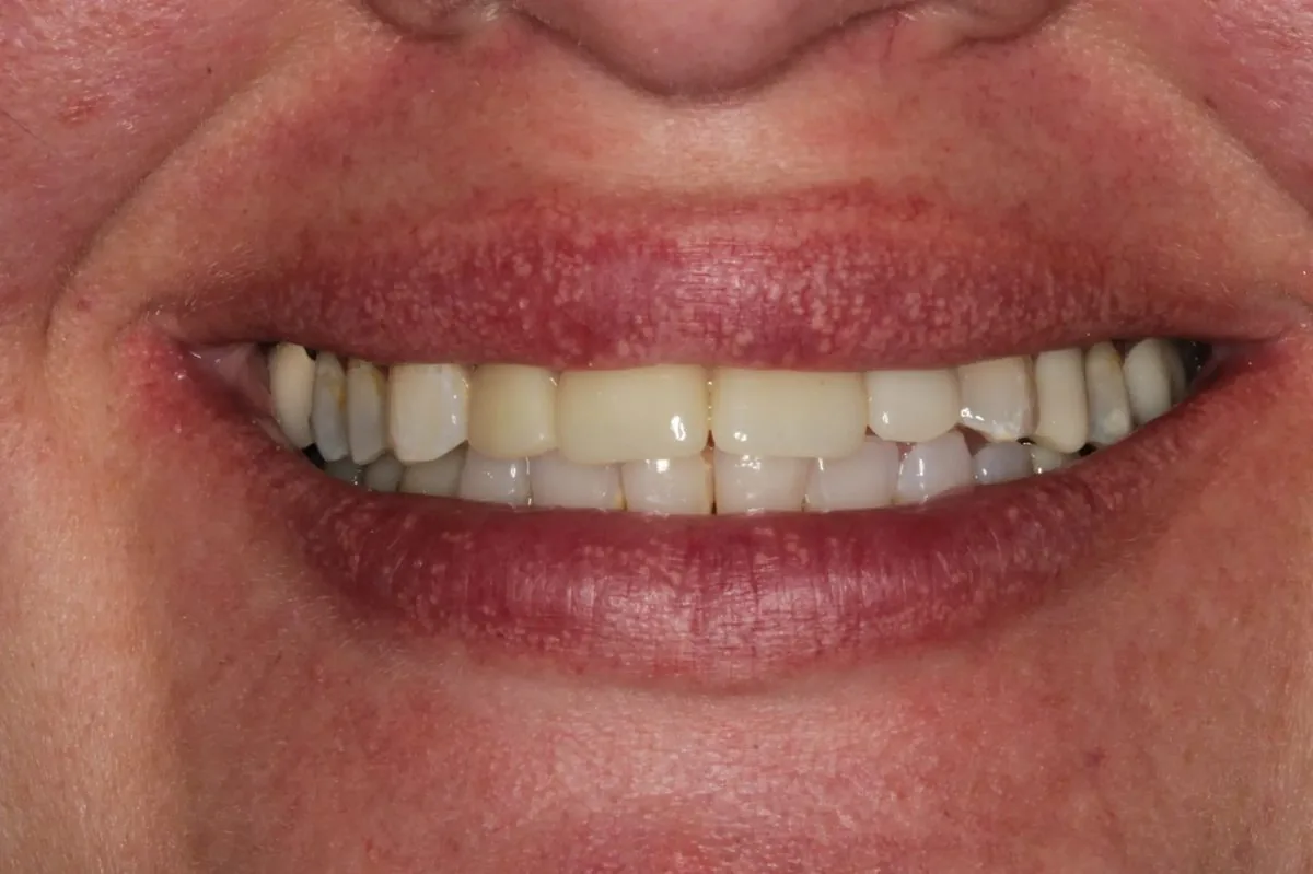 Catherine before — face showing guarded smile with mismatched teeth
