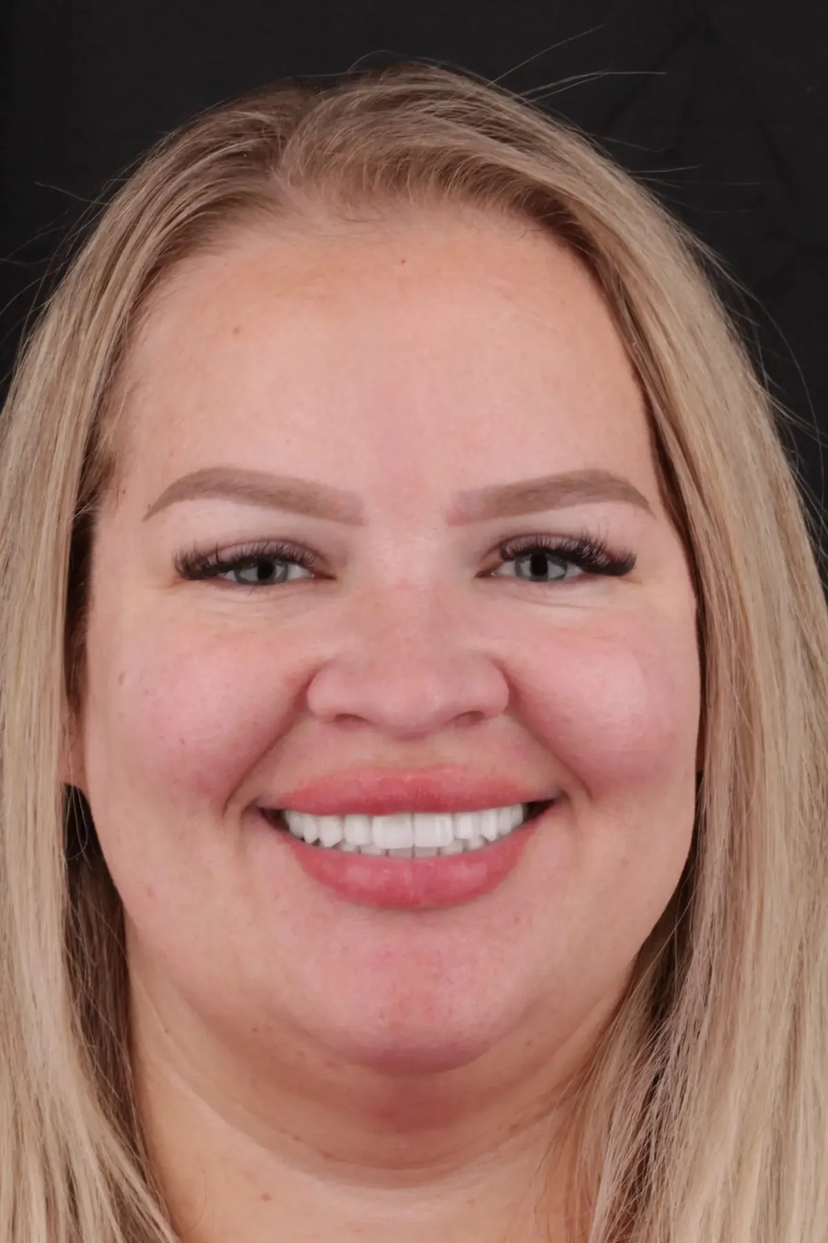 Catherine after 10-over-10 smile makeover — bright white E.max and composite restorations, shade OM