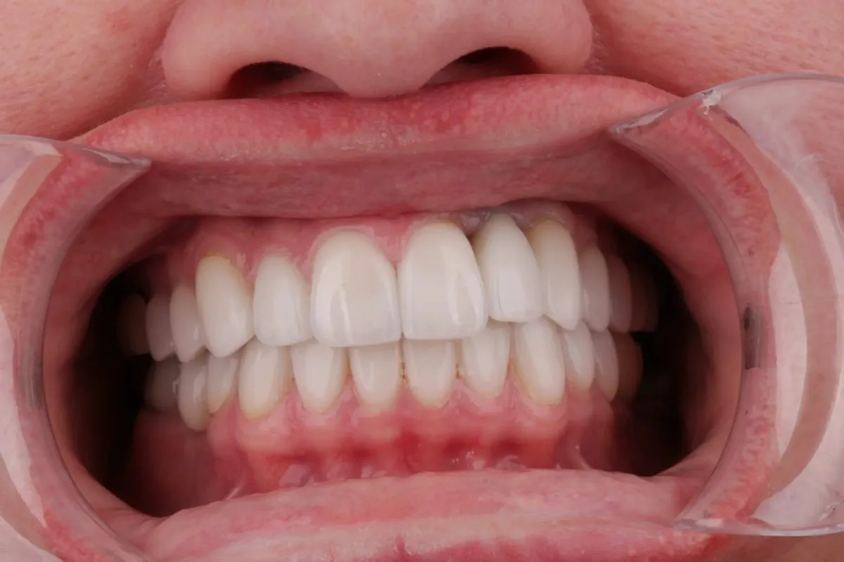 Catherine after — retracted view showing all 10 upper E.max restorations and lower composite veneers