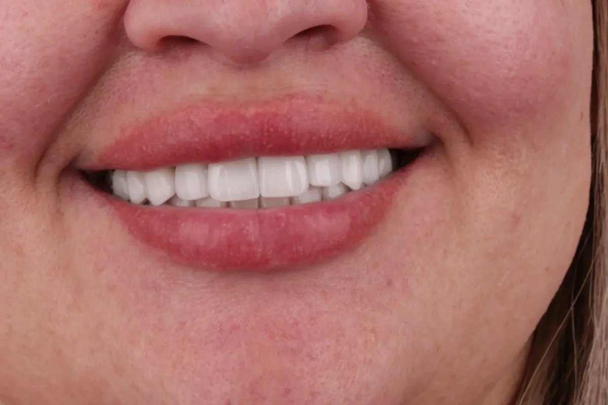 Catherine after — full bright smile with E.max veneers and composite, shade OM