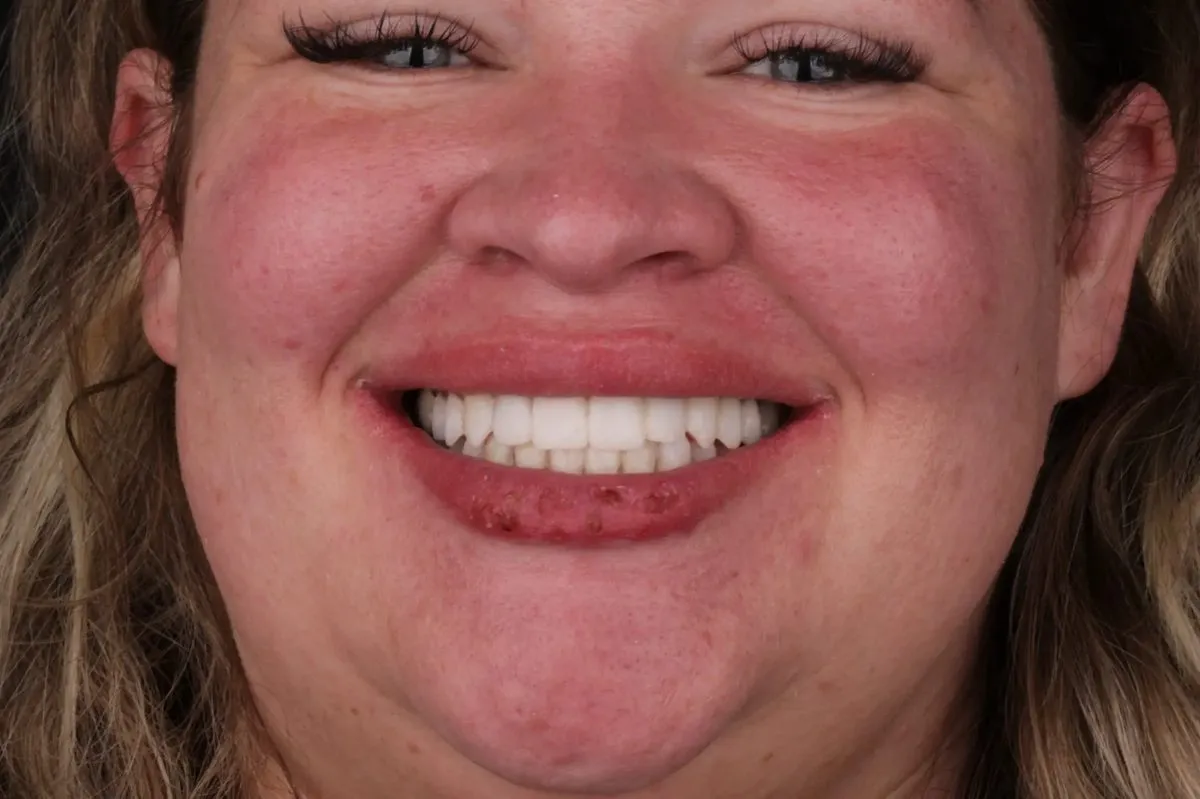 Catherine during treatment — temporaries in place showing smile design