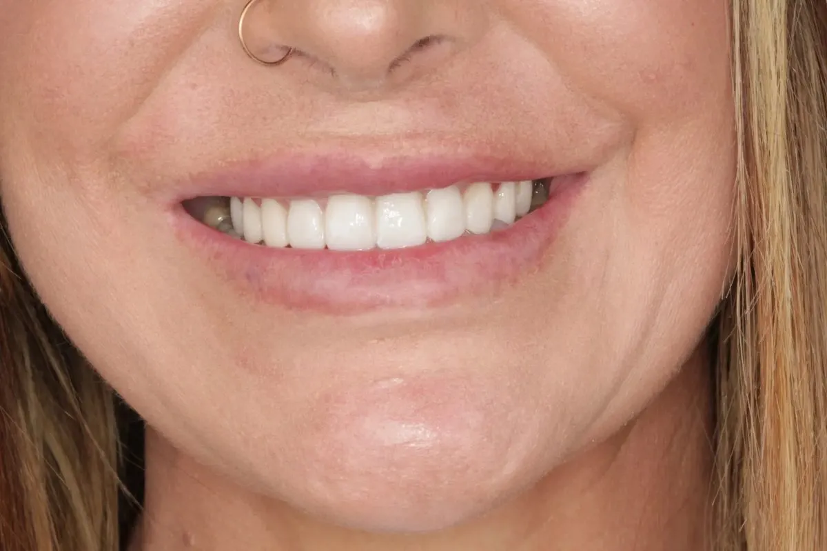 Cory after 10 porcelain veneers