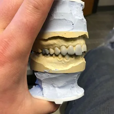 Diagnostic wax-up for full mouth porcelain veneers showing planned tooth design and bite correction