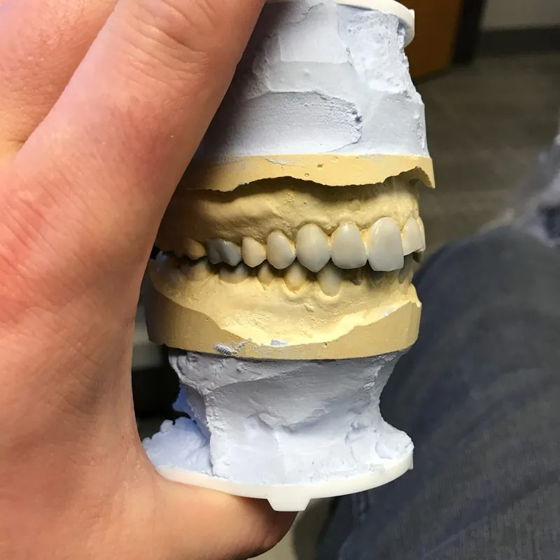 Diagnostic wax-up for full mouth porcelain veneer treatment planning