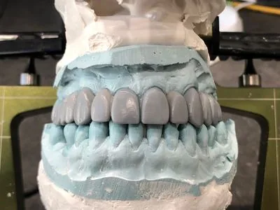 Diagnostic wax-up for implant smile reconstruction — planned tooth design on articulated stone...