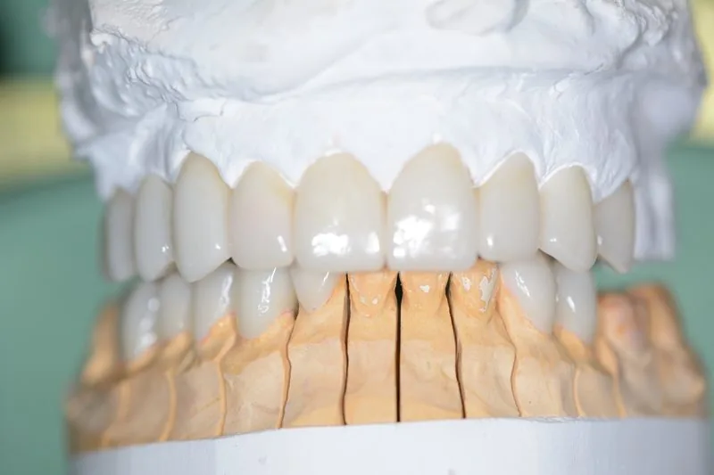 E.max porcelain veneers mounted on die model before cementation
