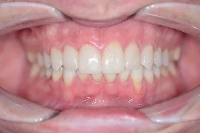 E.max porcelain veneers retracted view — final full mouth restorations with corrected tooth...