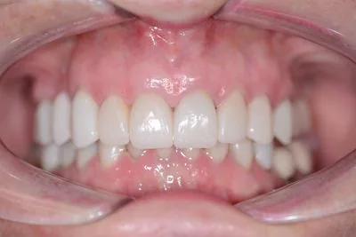 E.max porcelain veneers closeup — final restorations showing natural translucency and restored...