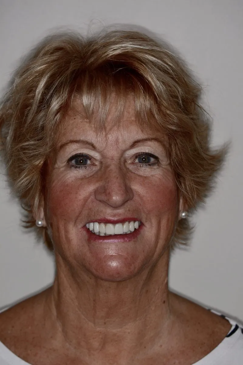After full mouth rehabilitation with E.max veneers and crowns — restored smile
