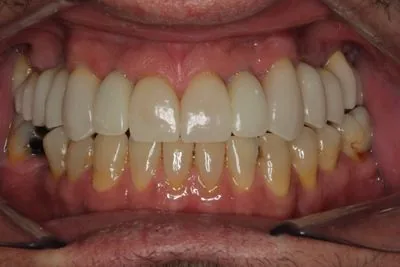 Implant crowns and E.max restorations retracted view after smile reconstruction — all missing...