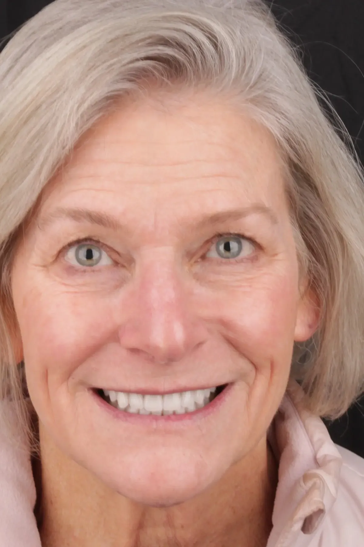 Joan after 24 E.max crowns — fully restored bite, bright white smile, shade A1