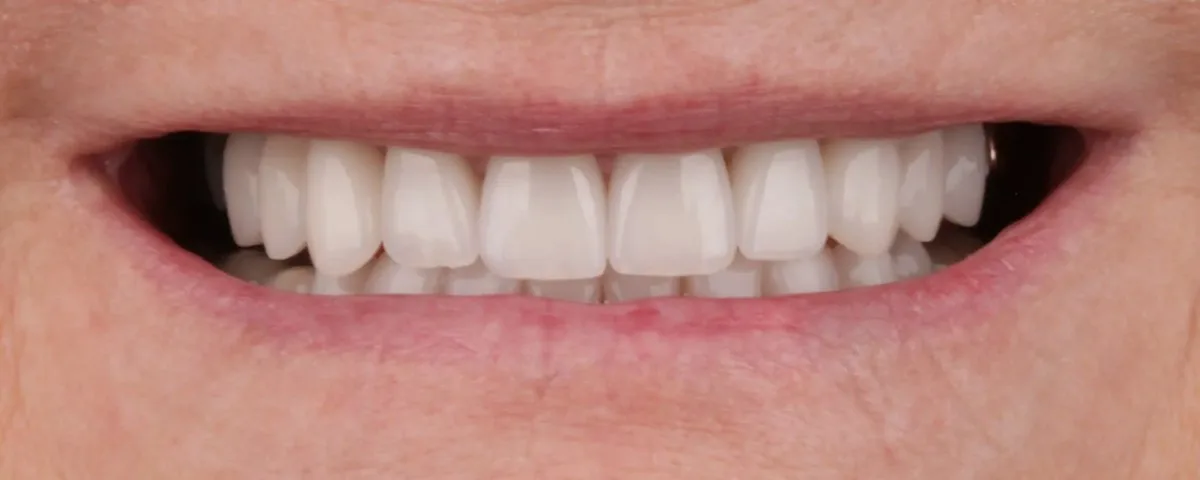 Joan after — close-up smile showing 24 E.max crowns in shade A1, full bite restored