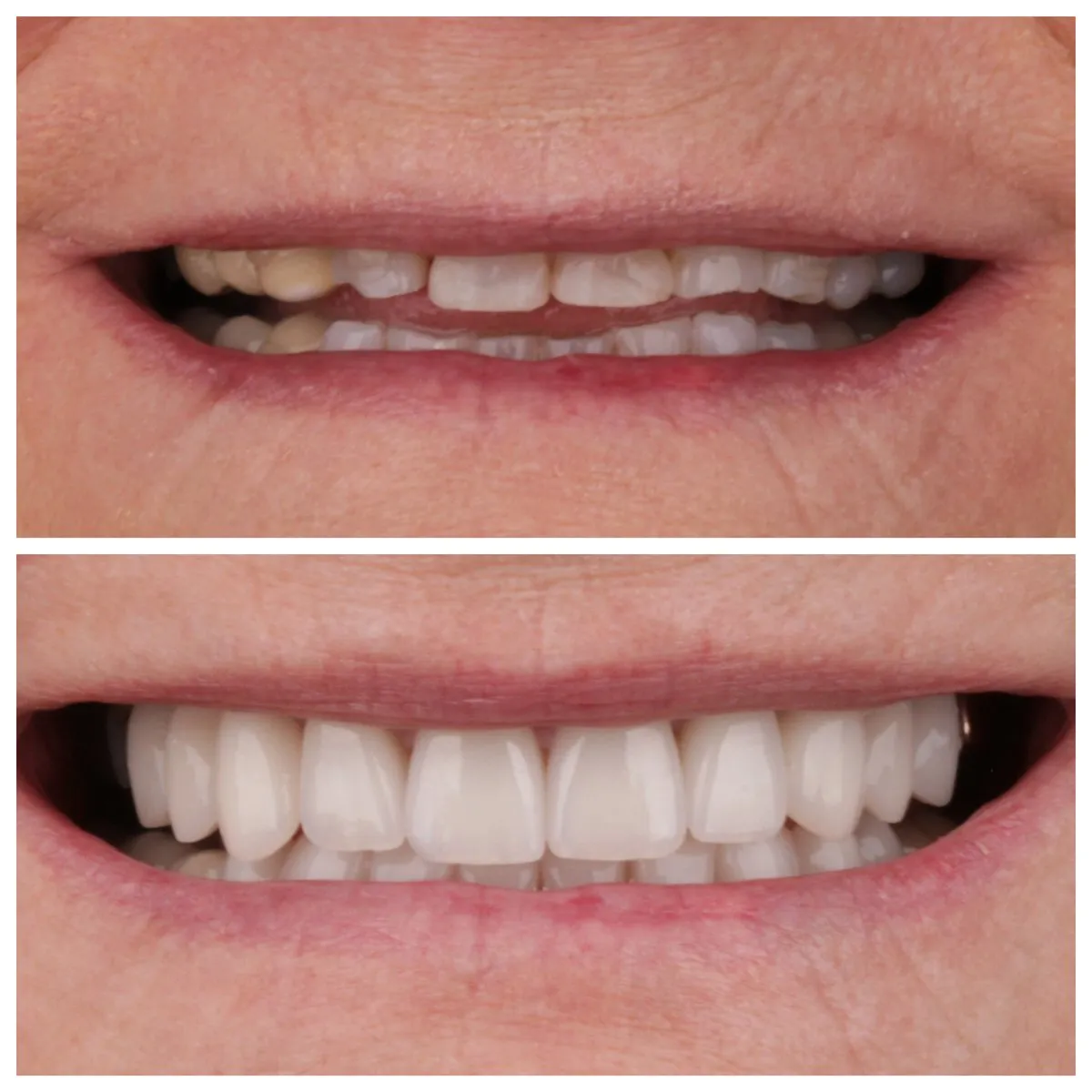 Joan before full-mouth rehabilitation — severely worn, broken, discolored teeth with collapsed bite