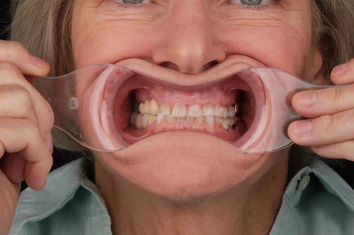 Joan before — retracted view showing severely worn, short, broken teeth with collapsed...