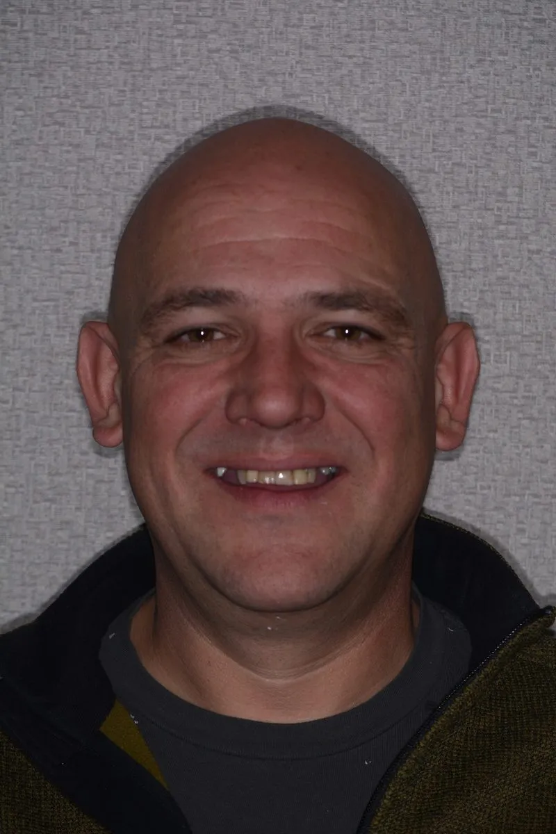 Before implant smile reconstruction showing missing teeth and edge-to-edge bite