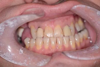 Missing teeth and edge-to-edge bite retracted clinical view before implant crowns and...