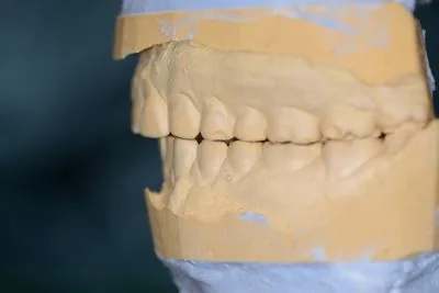 Mounted dental models before porcelain veneers showing worn teeth and collapsed bite from bruxism
