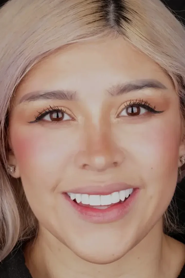 Apollonia after 10 composite veneers