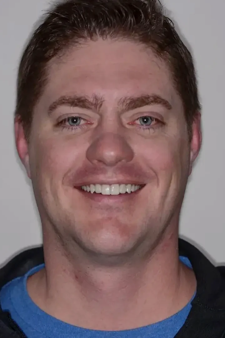 Brandon after 20 veneers across two arches