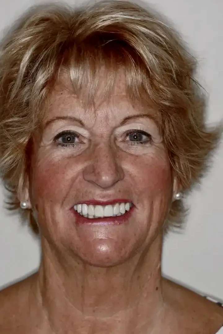 Joanne after full-mouth reconstruction