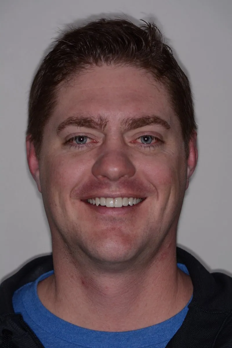 After smile restoration with full arch E.max veneers and crowns
