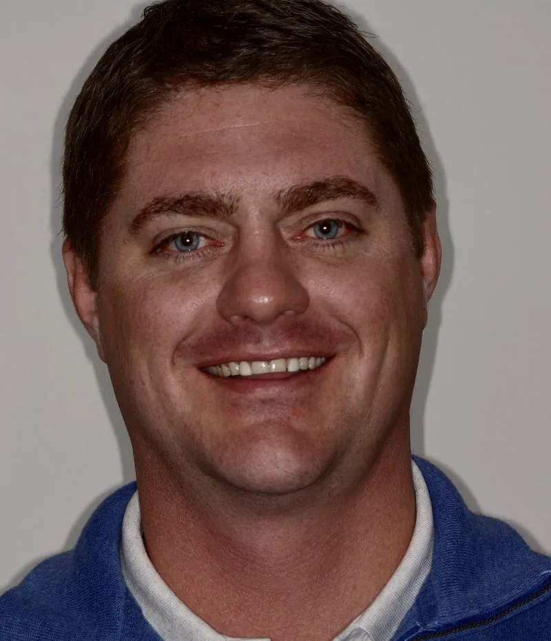 Before smile restoration showing worn teeth from bruxism