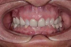 Severely worn teeth closeup before porcelain veneers — collapsed bite and loss of tooth structure