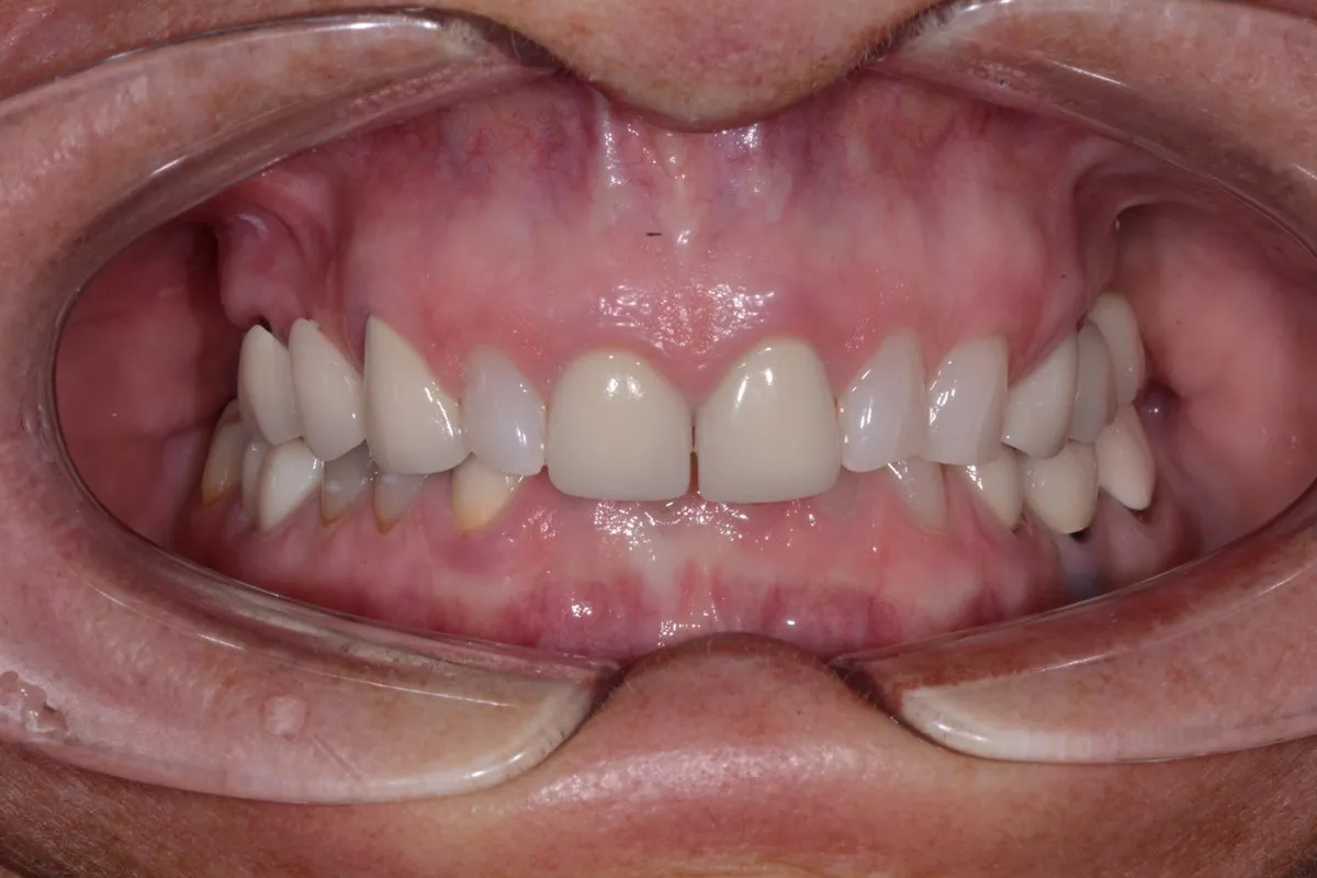 Severely worn teeth from bruxism before porcelain veneer restoration