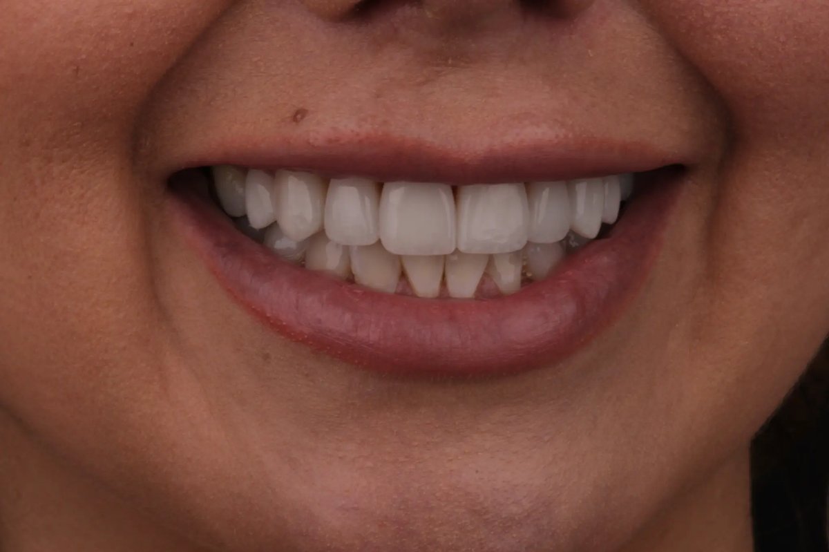 Shantel's Case after veneers