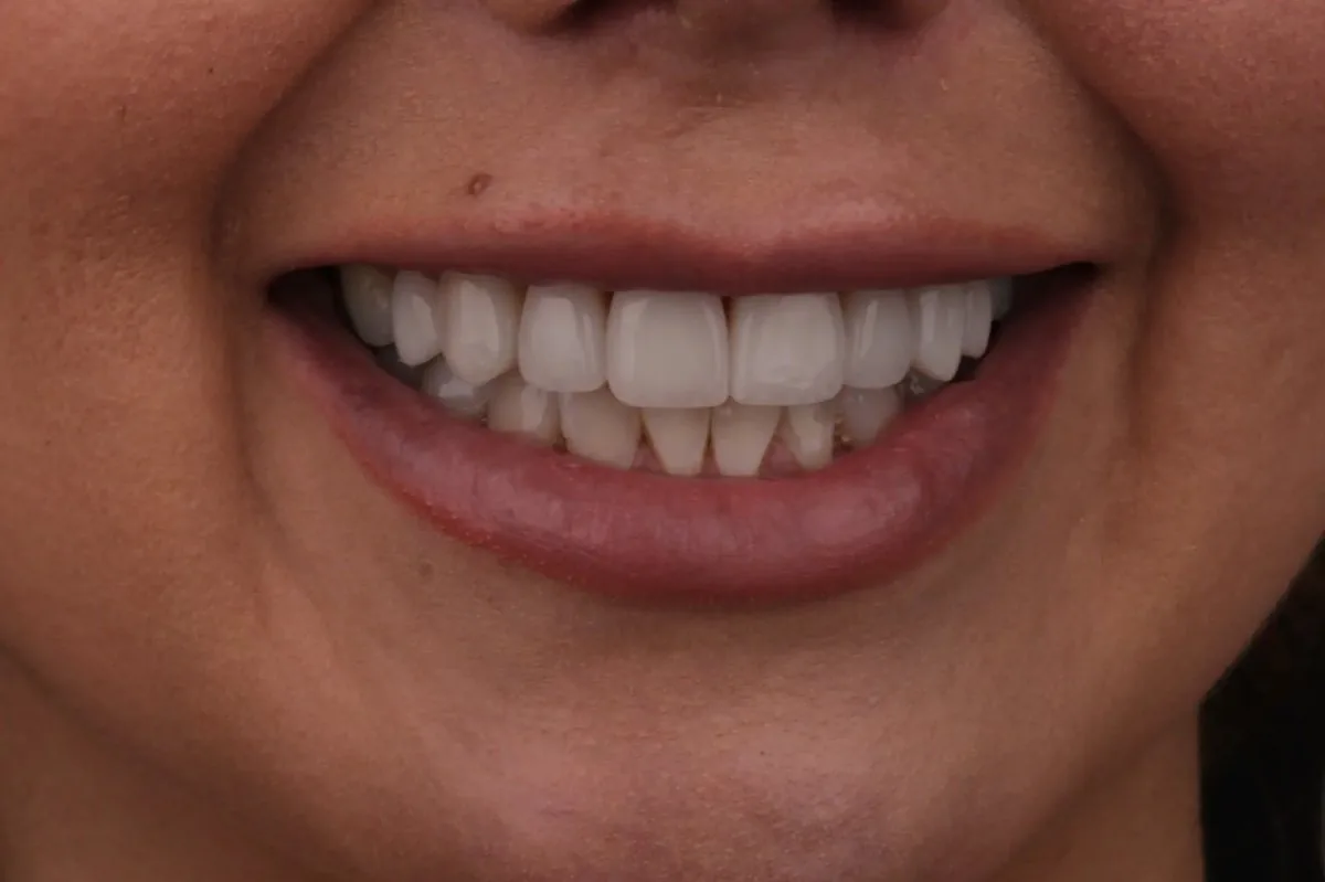 Shantel after porcelain veneers