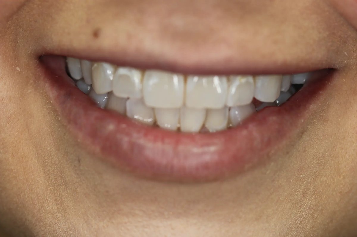 Shantel before — close-up showing uneven coloration and slightly dull teeth