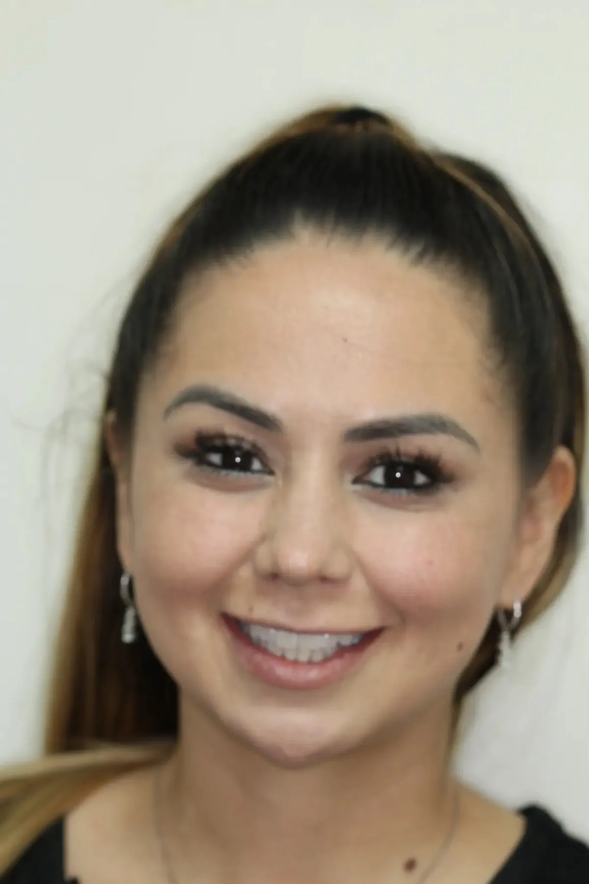 Shantel before porcelain veneers